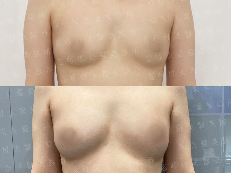 抽脂補胸
