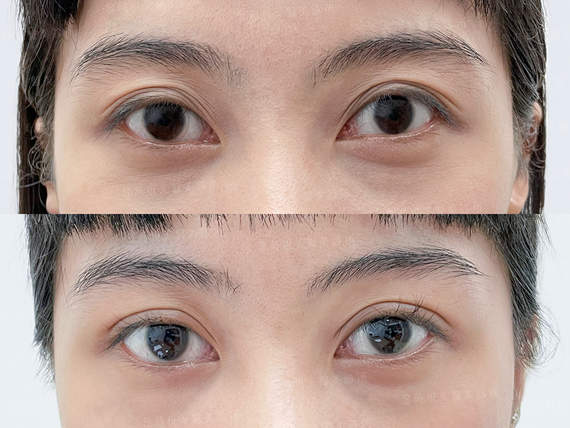 縫雙眼皮